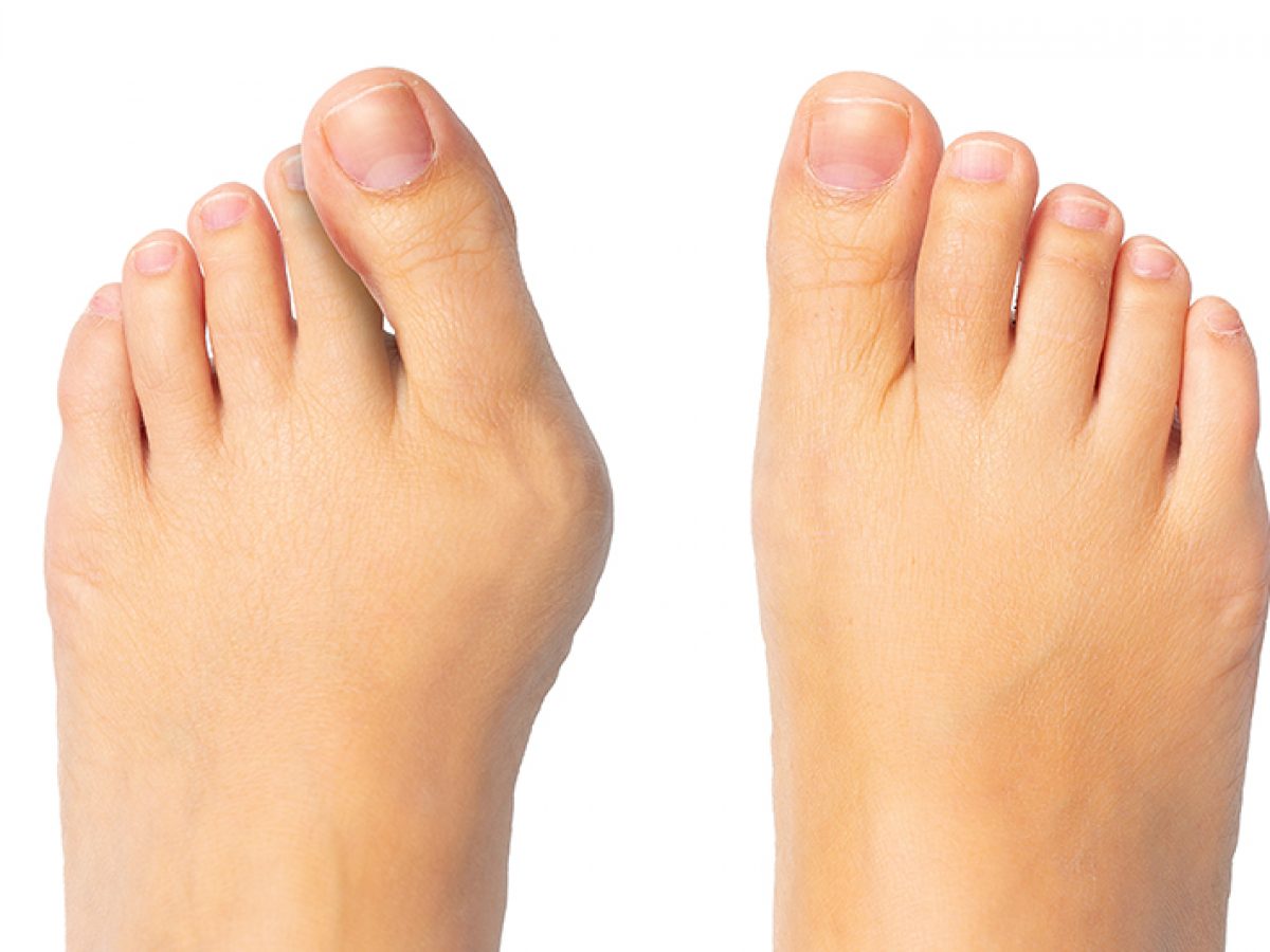 shoes for hallux valgus